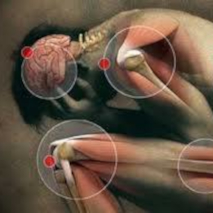 síndrome dolor miofascial